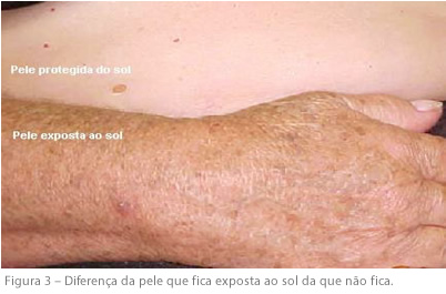 pele_protegida
